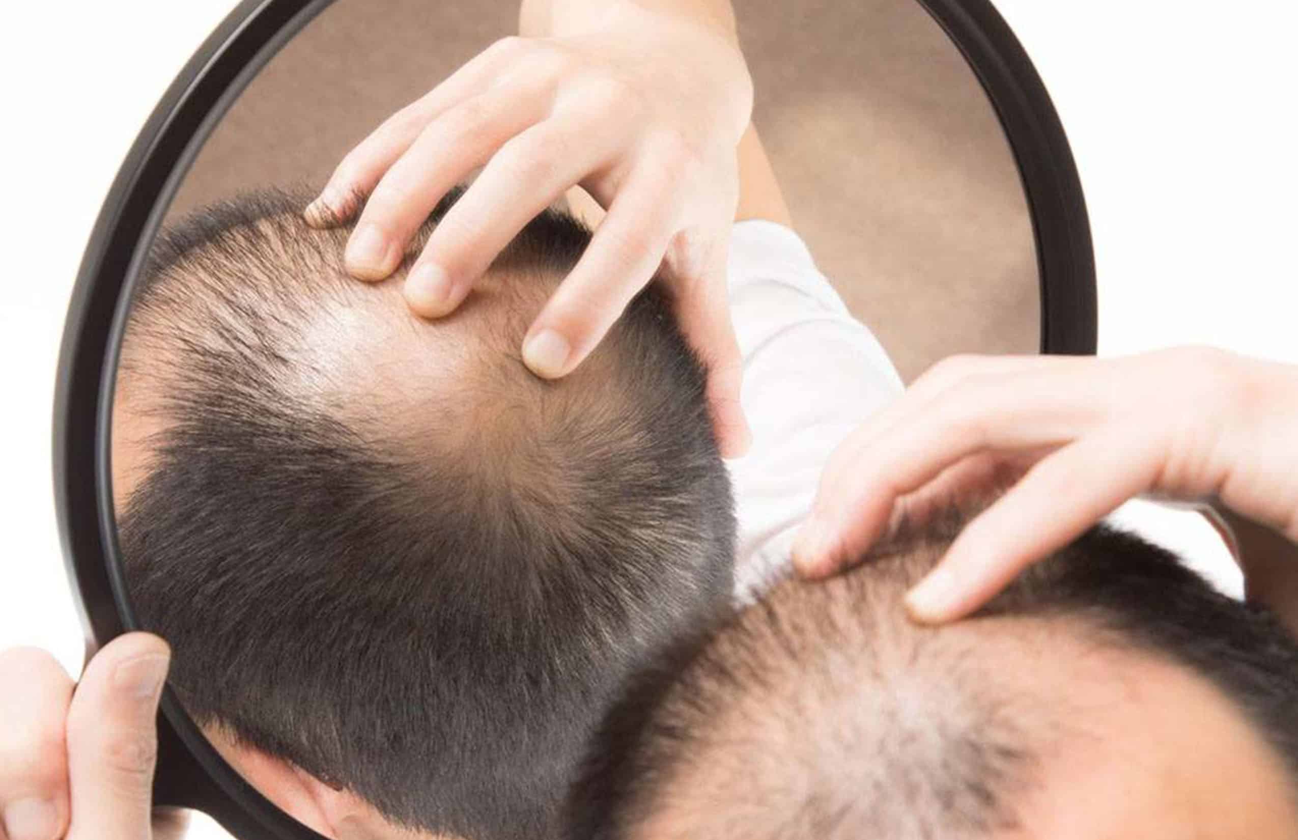 Alopecia Androgenética en Chihuahua