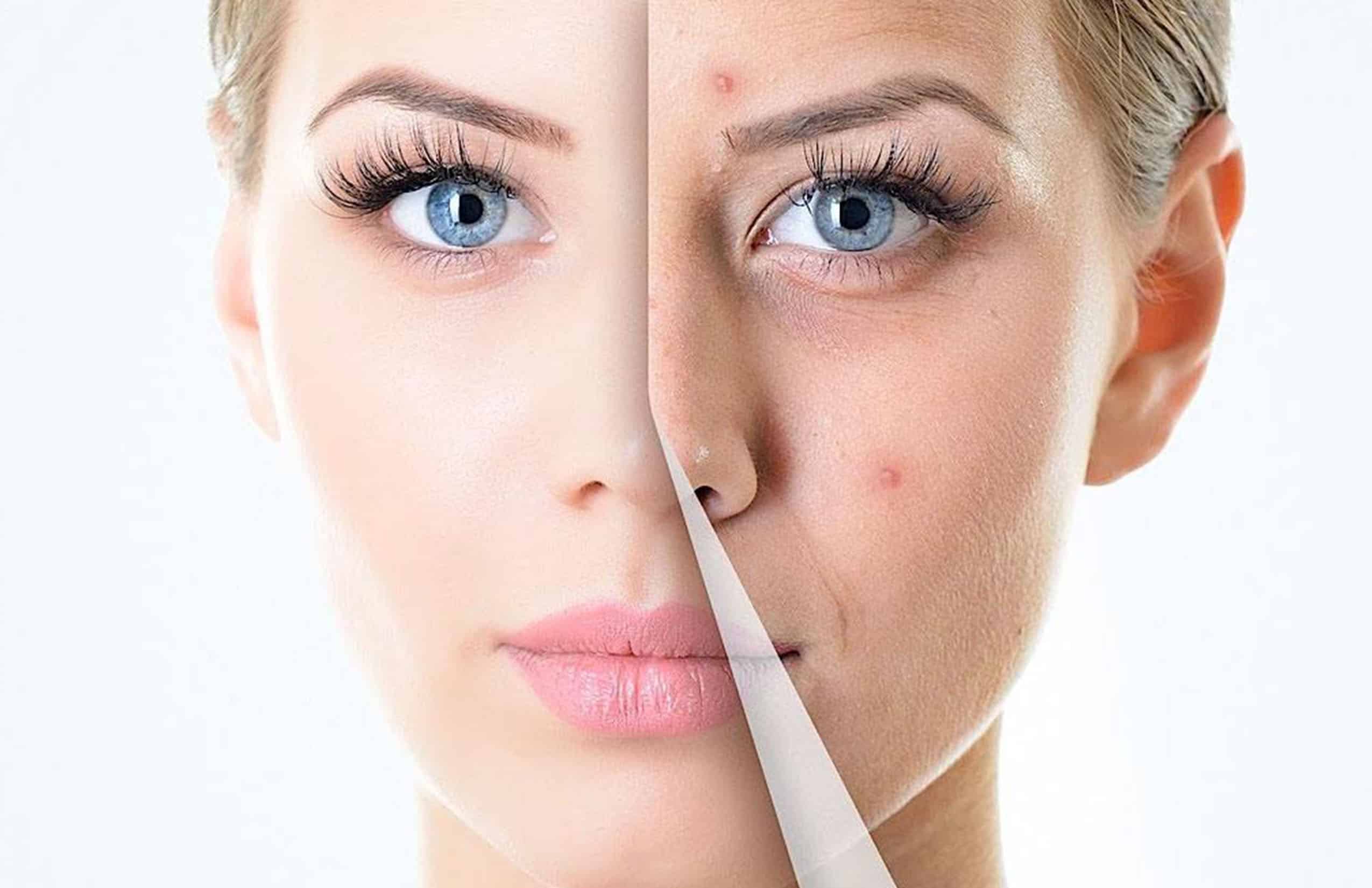 Peeling en Chihuahua